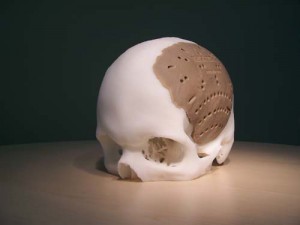 OsteoFab Patient Specific Cranial Device